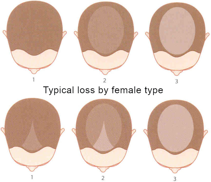 Типичная потеря волос по женскому типу
