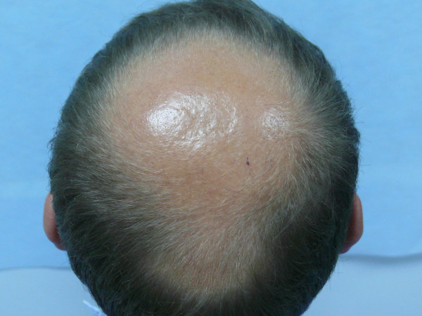 Признаки выпадения волос у мужчин